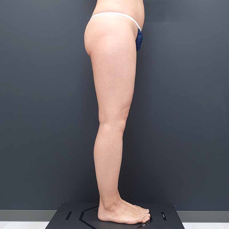 20250531_ N171783_tukahara_thigh-liposuction①Before