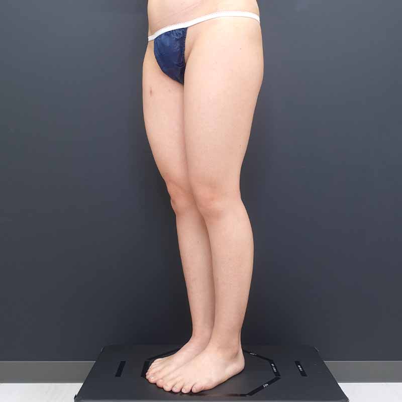 20250531_ N171783_tukahara_thigh-liposuction①Before