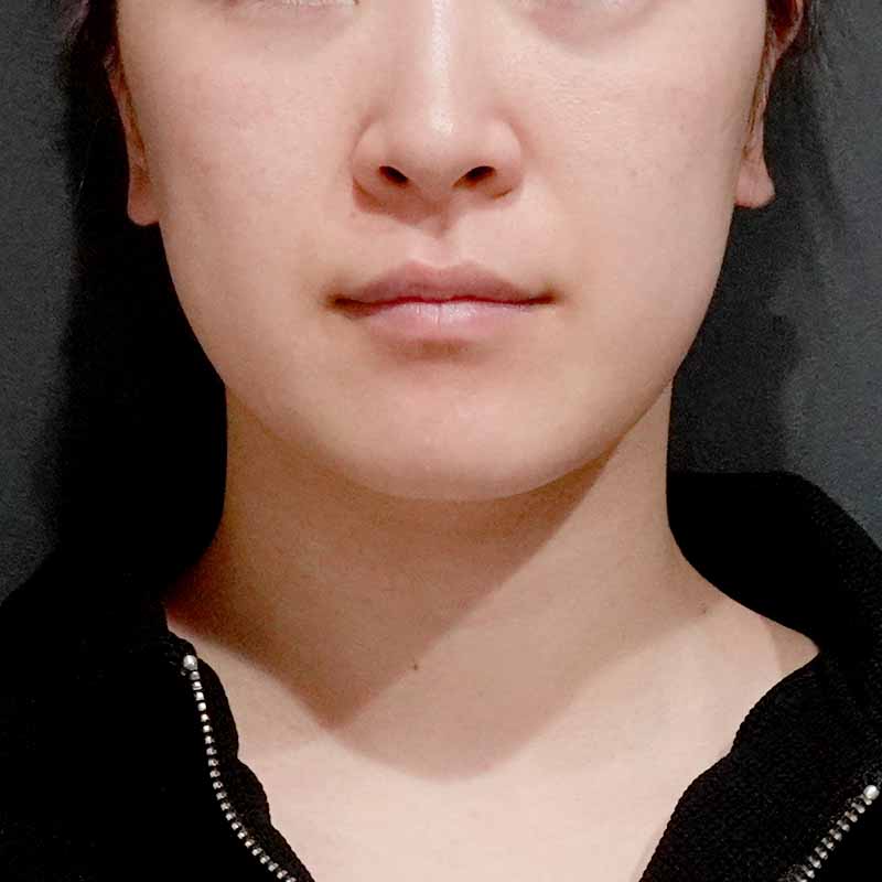 20250531_ S26738_hurumura_face-liposuction_philtrum-botox①After