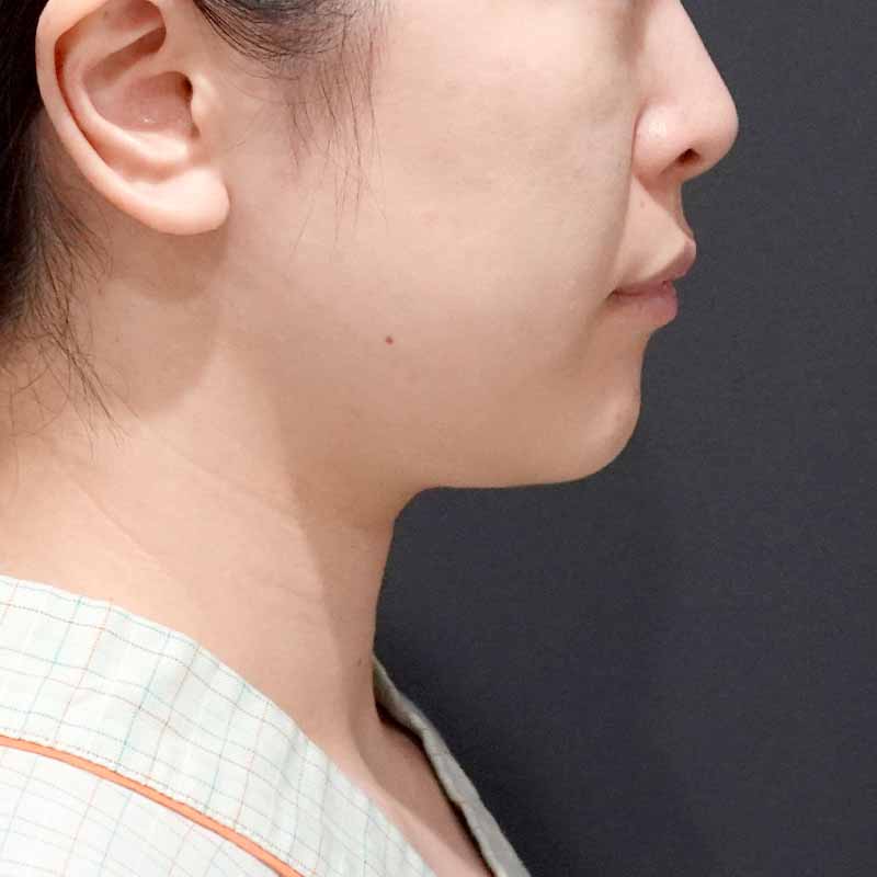 20250531_ S26738_hurumura_face-liposuction_philtrum-botox②Before