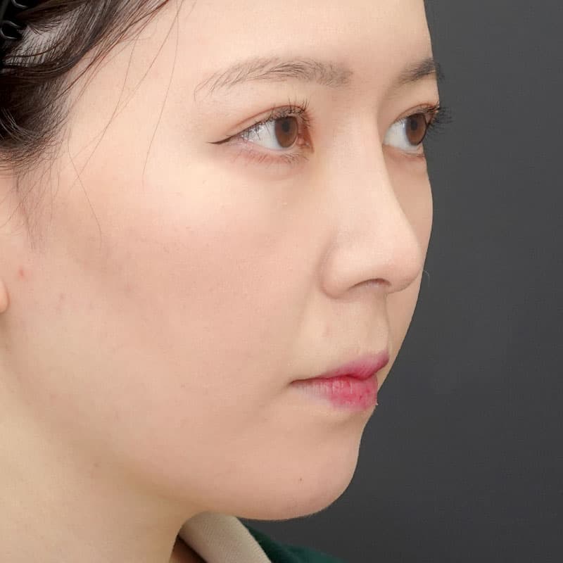20250531_N34321_morishima_nasalseptum-extension①After