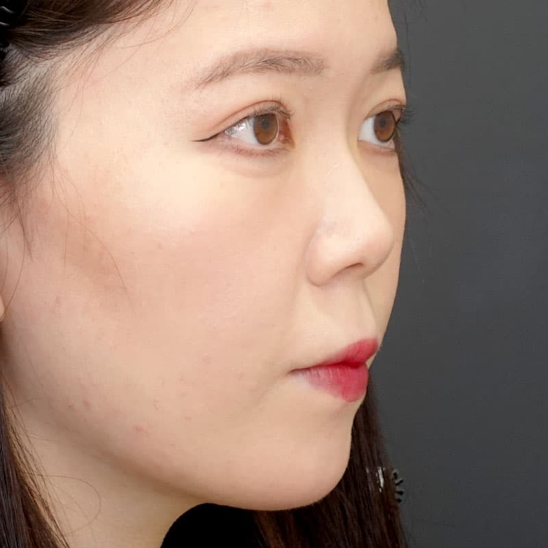 20250531_N34321_morishima_nasalseptum-extension①Before