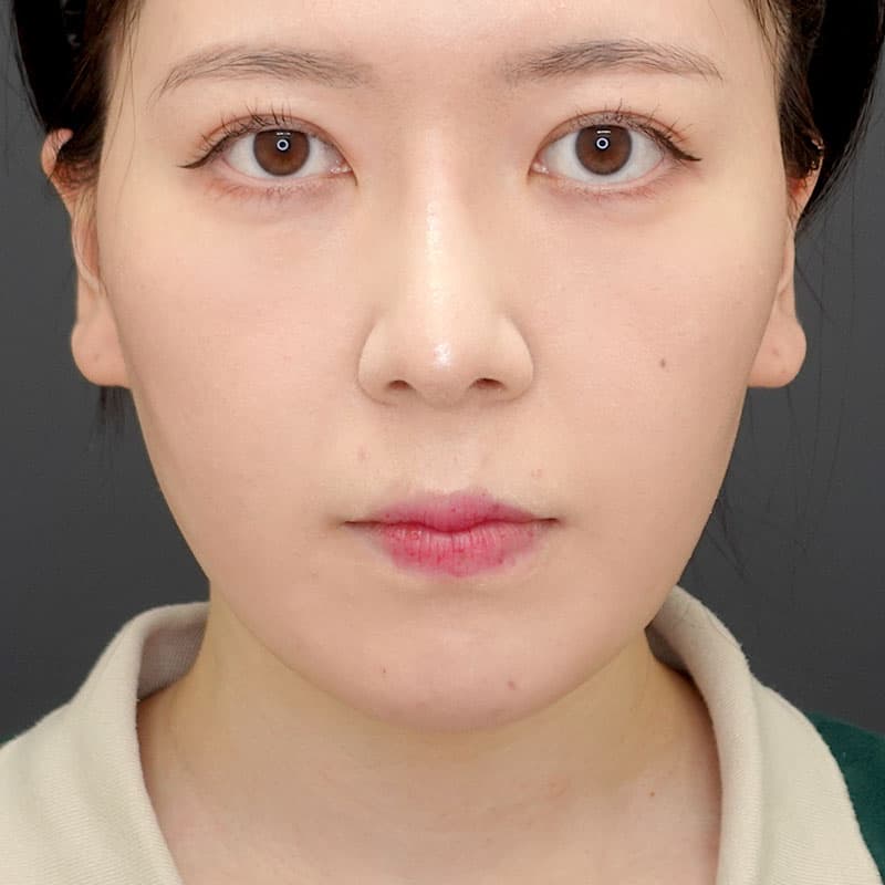 20250531_N34321_morishima_nasalseptum-extension②After