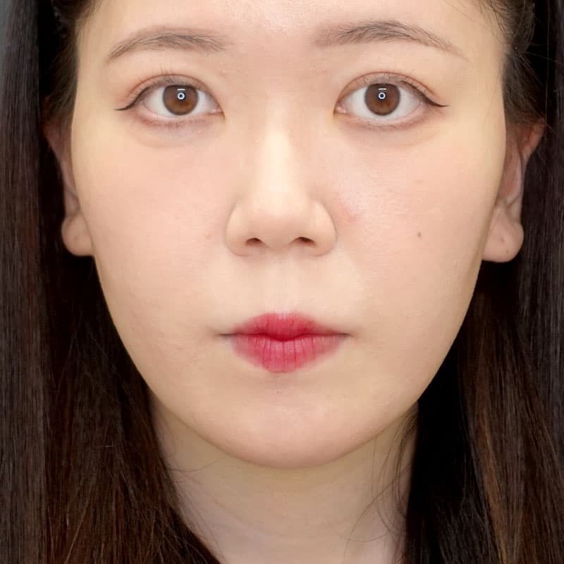20250531_N34321_morishima_nasalseptum-extension②Before
