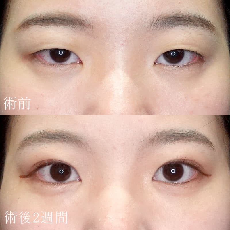 常盤医師二重埋没法症例写真