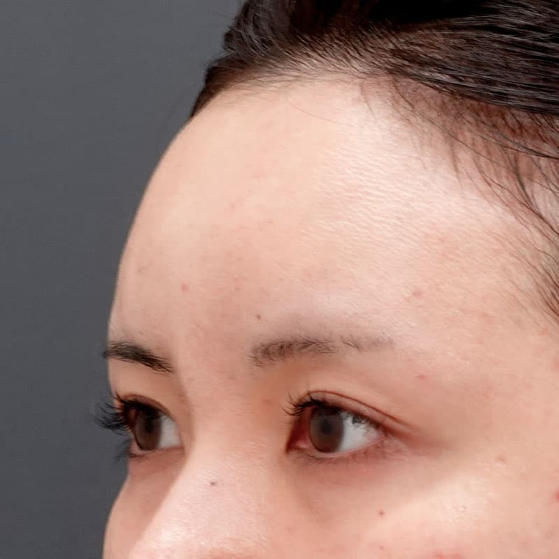20250625_N126971_matori_hyaluronic forehead①After