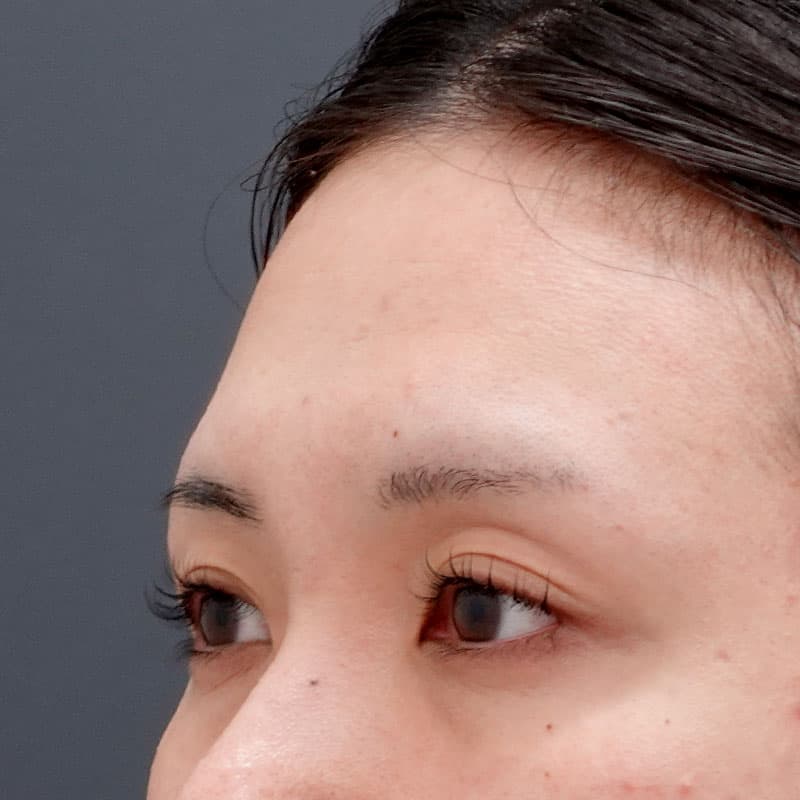 20250625_N126971_matori_hyaluronic forehead①Before