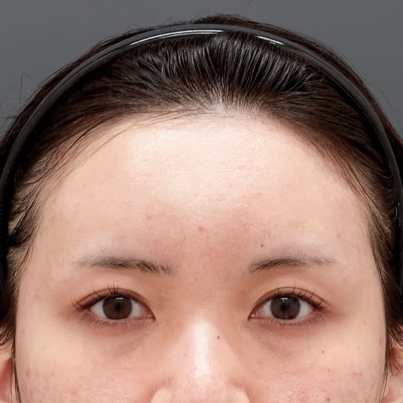 20250625_N126971_matori_hyaluronic forehead②After