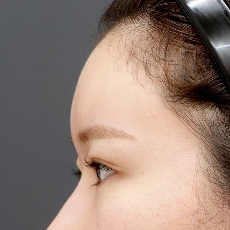 20250625_N127148_matori_hyaluronic forehead①After