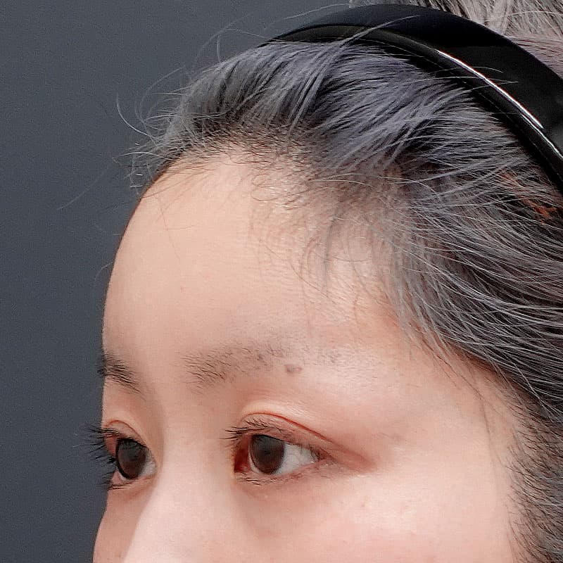 20250625_N128751_matori_hyaluronic forehead①After