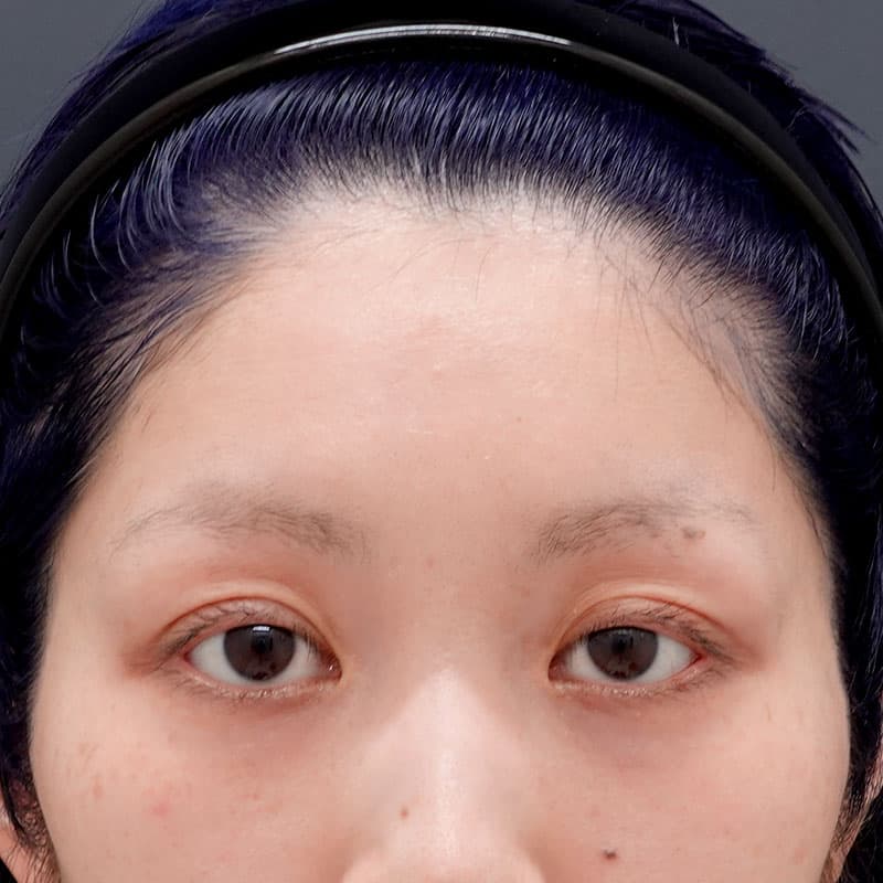 20250625_N128751_matori_hyaluronic forehead②Before