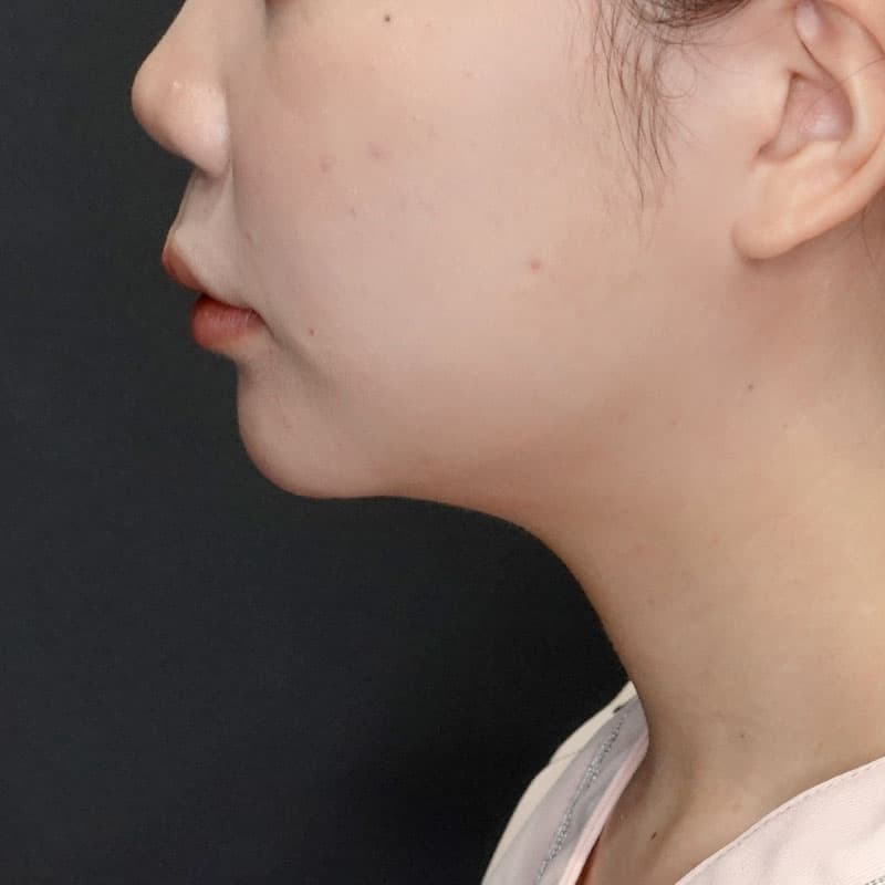 20250625_St20250625_nakamura_face-liposuction①After