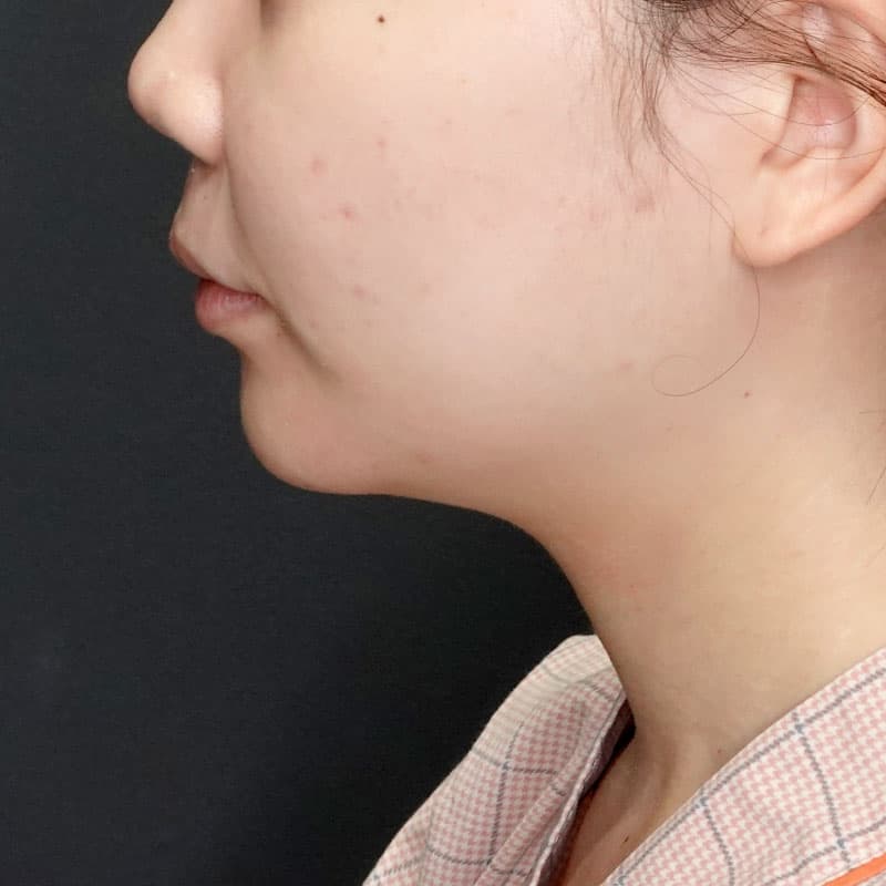 20250625_St20250625_nakamura_face-liposuction①Before