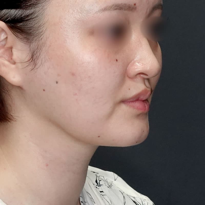 20250712_G30695_takemura_face-liposuction_masseter-muscle-botox①After