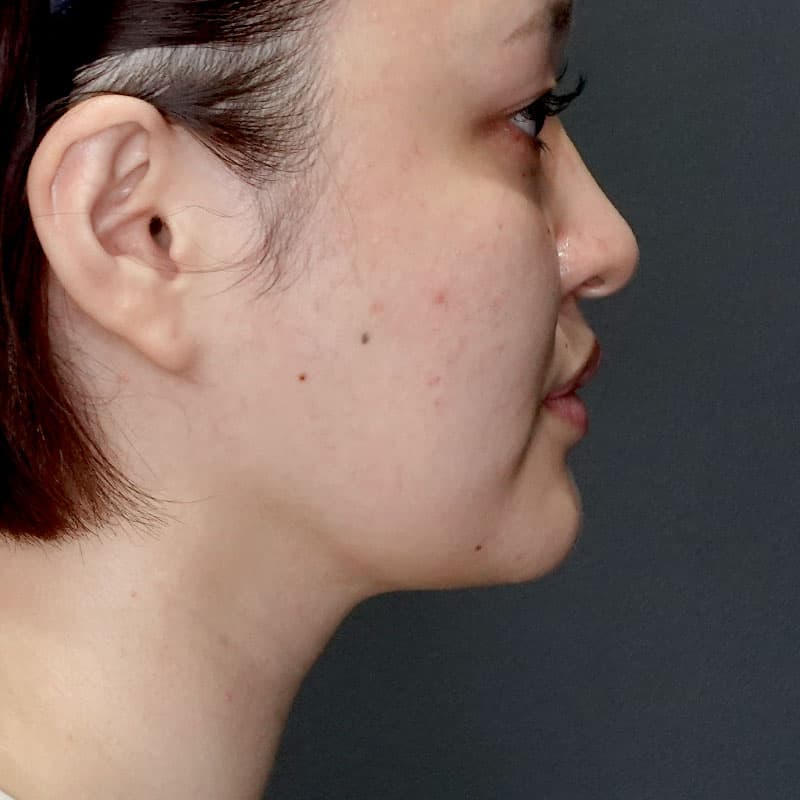 20250712_G30695_takemura_face-liposuction_masseter-muscle-botox②After