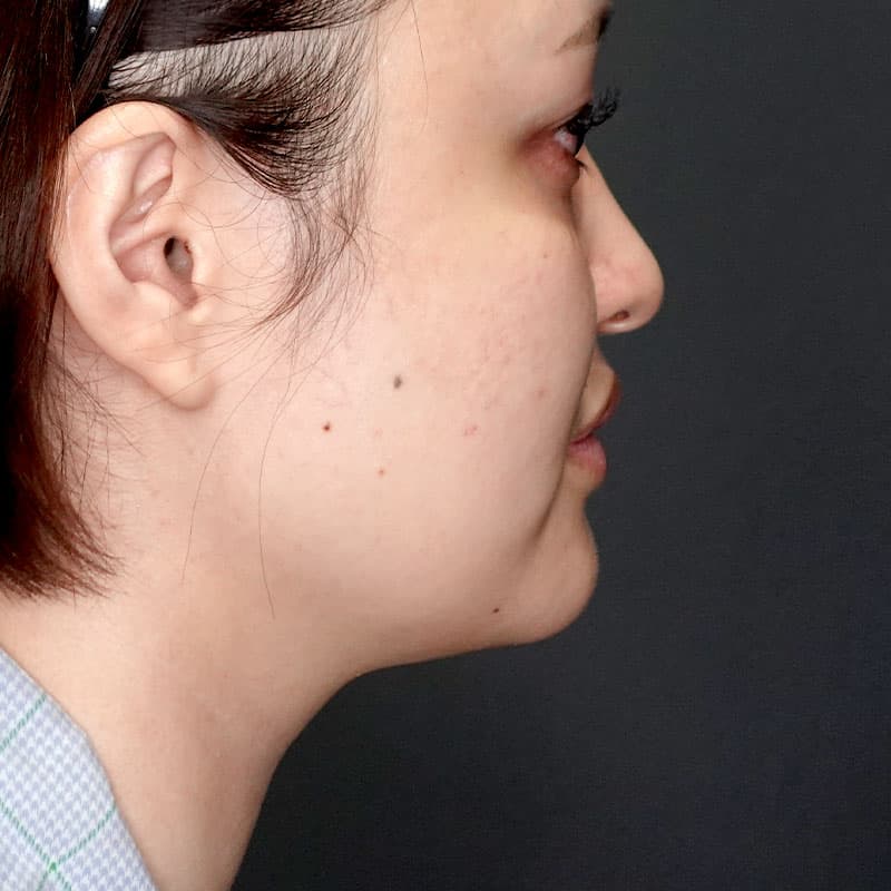 20250712_G30695_takemura_face-liposuction_masseter-muscle-botox②Before