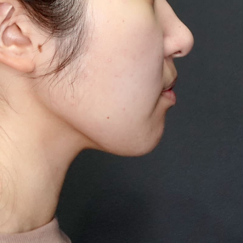 20250712_G33482_takemura_face-liposuction_masseter-muscle-botox①After