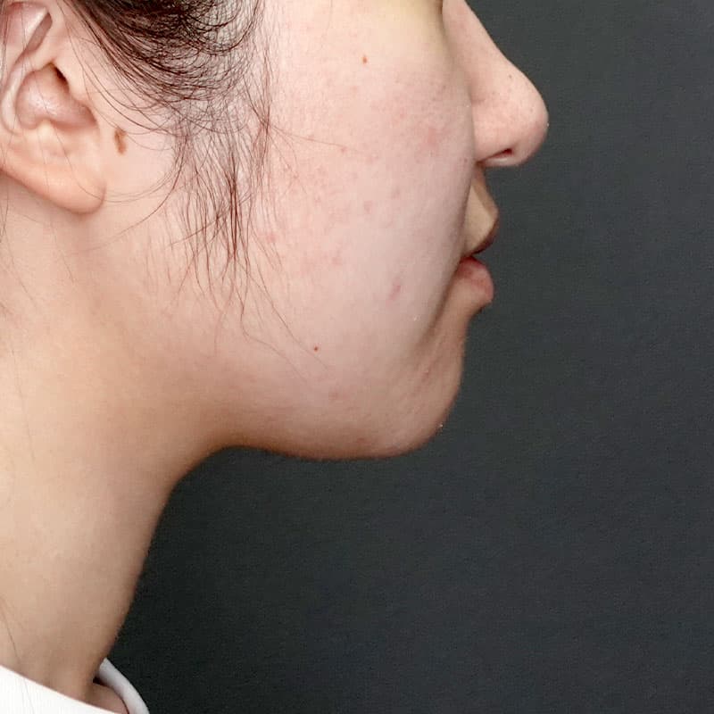 20250712_G33482_takemura_face-liposuction_masseter-muscle-botox①Before