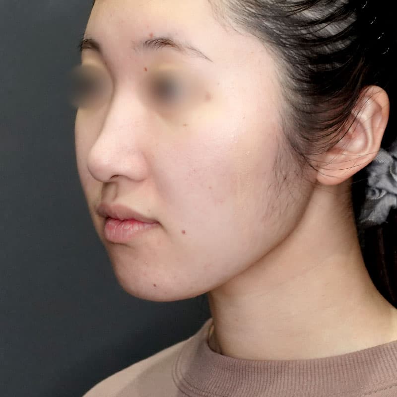20250712_G33482_takemura_face-liposuction_masseter-muscle-botox②After
