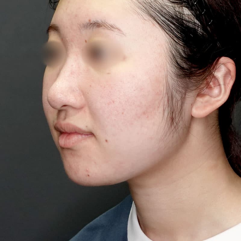 20250712_G33482_takemura_face-liposuction_masseter-muscle-botox②Before