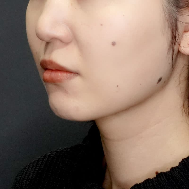20250712_G33761_takemura_face-liposuction_masseter-muscle-botox②After
