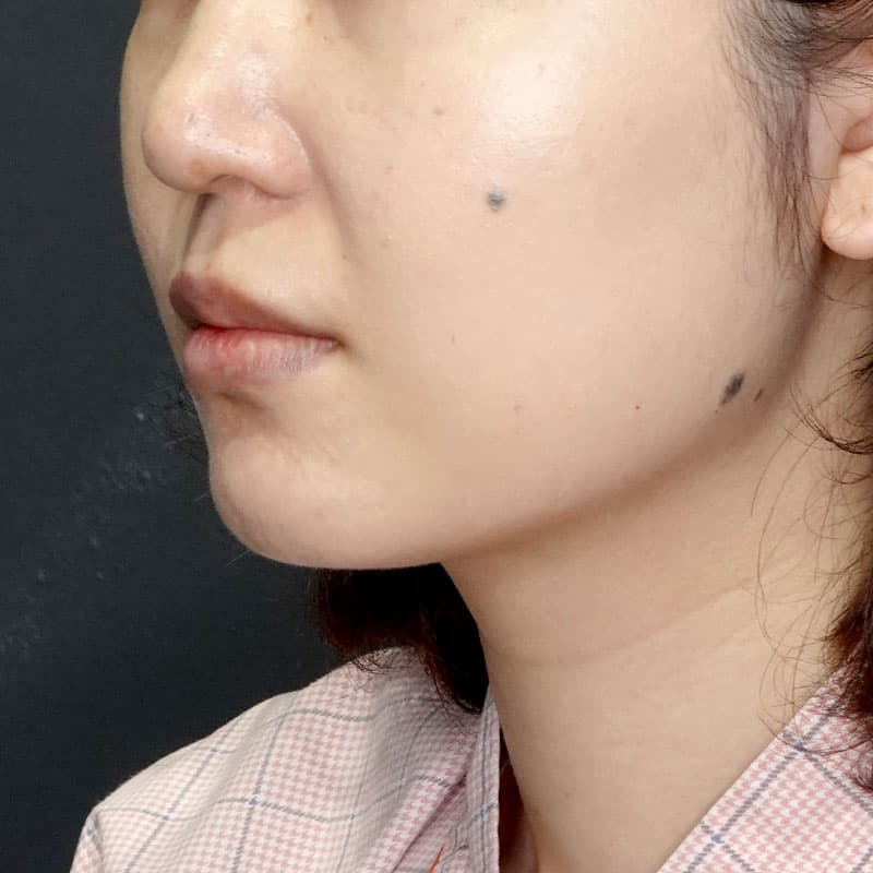 20250712_G33761_takemura_face-liposuction_masseter-muscle-botox②Before