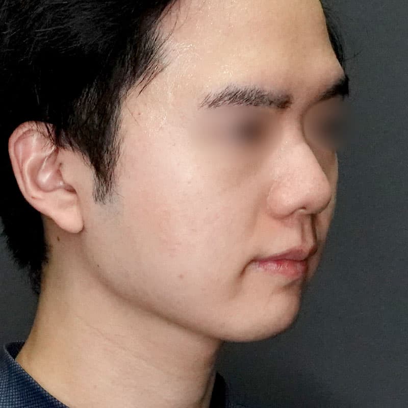 20250712_G37435_takemura_face-liposuction_masseter-muscle-botox①After