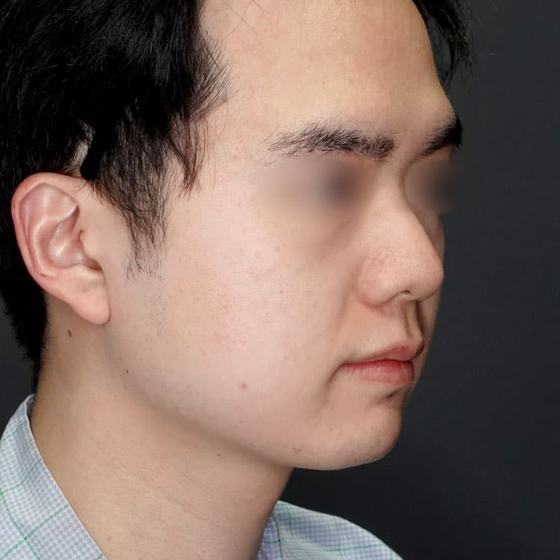 20250712_G37435_takemura_face-liposuction_masseter-muscle-botox①Before