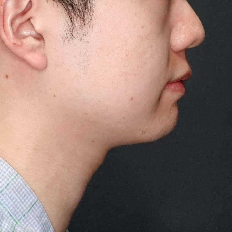 20250712_G37435_takemura_face-liposuction_masseter-muscle-botox②Before