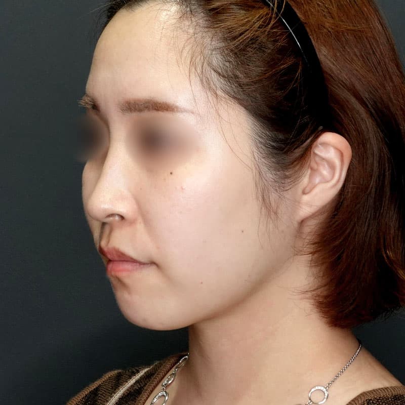 20250712_G39642_takemura_face-liposuction_masseter-muscle-botox①After