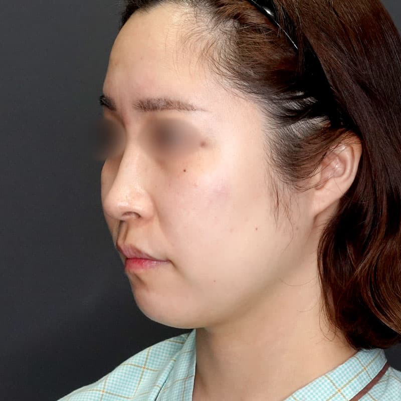 20250712_G39642_takemura_face-liposuction_masseter-muscle-botox①Before