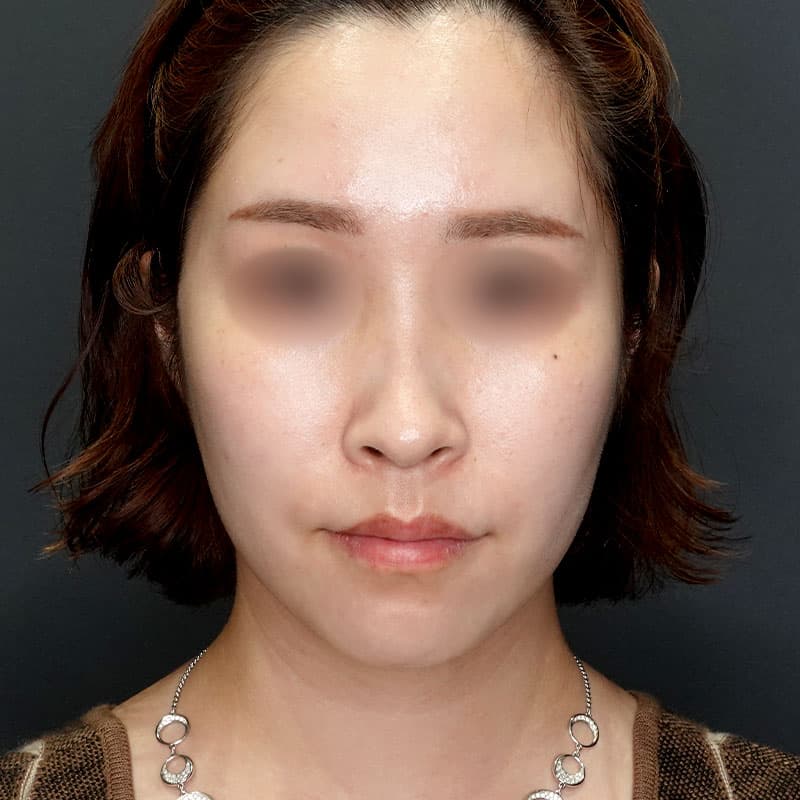20250712_G39642_takemura_face-liposuction_masseter-muscle-botox③After