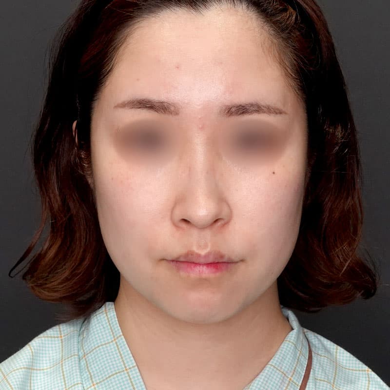 20250712_G39642_takemura_face-liposuction_masseter-muscle-botox③Before