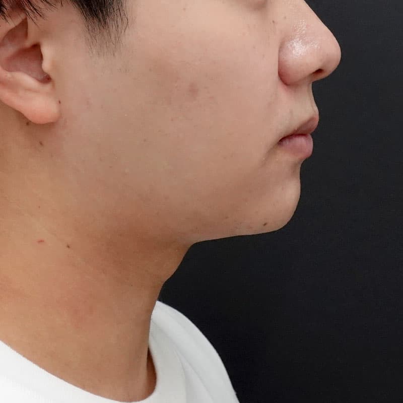 20250712_S108956_furumura_face-liposuction_masseter-muscle-botox②After