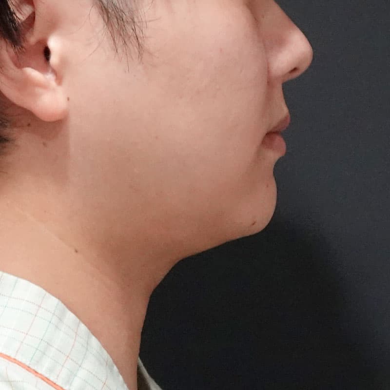 20250712_S108956_furumura_face-liposuction_masseter-muscle-botox②Before