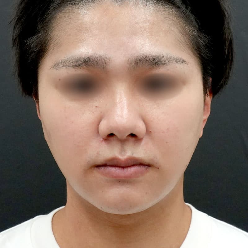 20250712_S108956_furumura_face-liposuction_masseter-muscle-botox③After