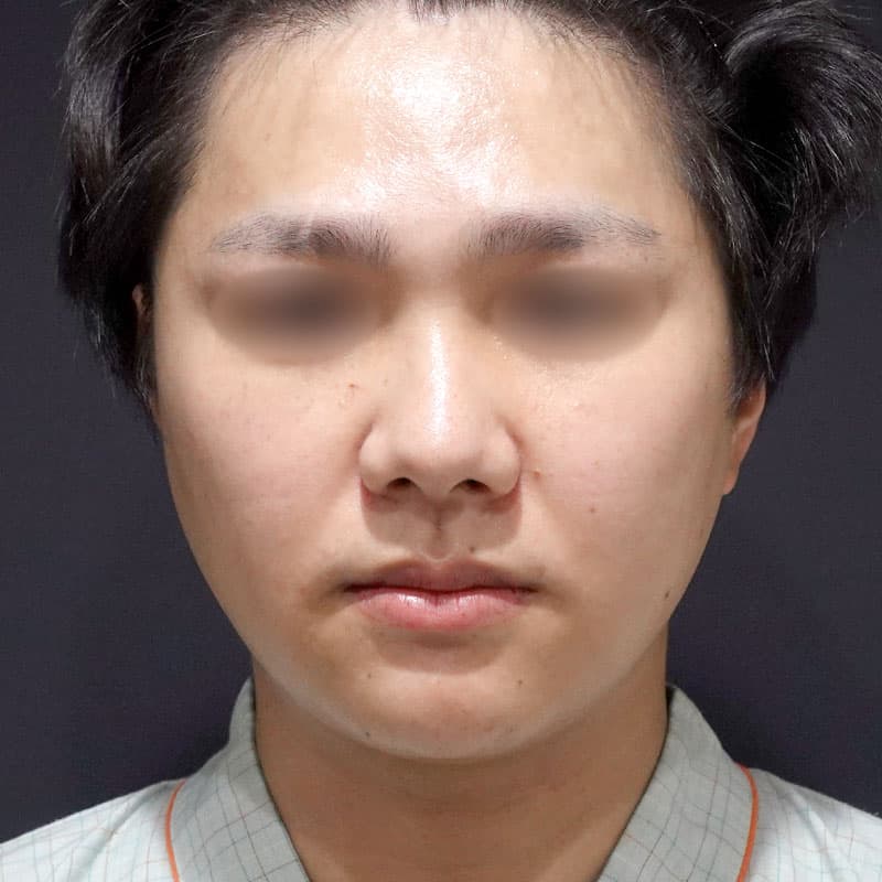 20250712_S108956_furumura_face-liposuction_masseter-muscle-botox③Before