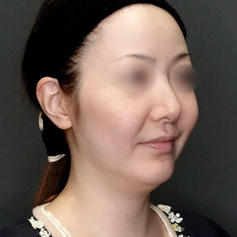 20250727_G38148_volnewmer②Before