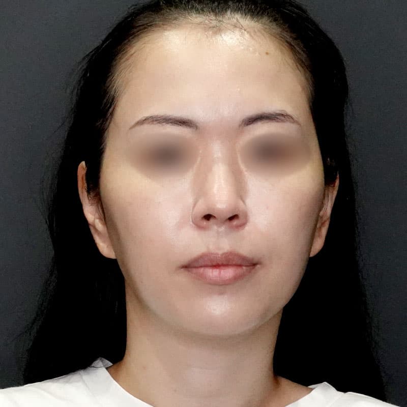 20250727_N171783_takee_face-liposuction①After