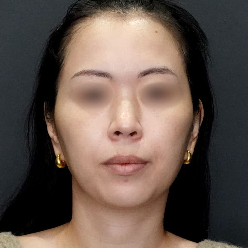 20250727_N171783_takee_face-liposuction①Before