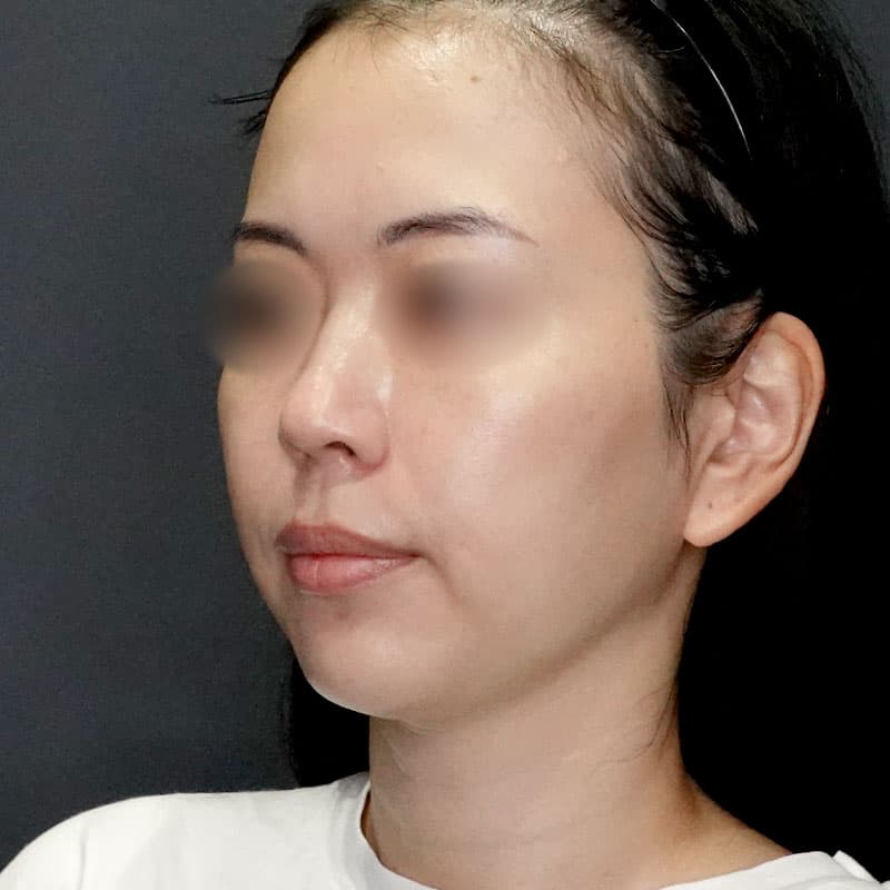20250727_N171783_takee_face-liposuction②After