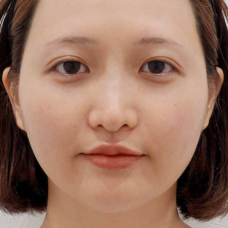 20250819_G143217 _kadoya_hyaluronic jaw lips nose①After