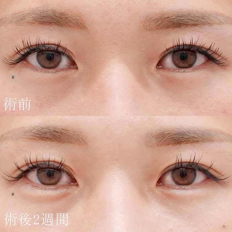 20250819_N135790_sakai_hyaluronic eye bagsメイン横