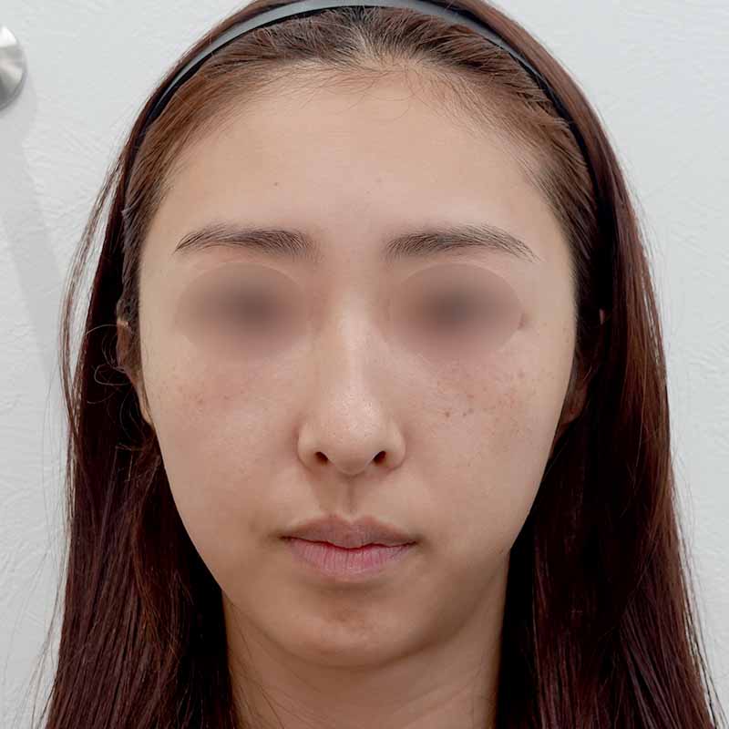 20250822_G144971_kadoya_hyaluronic forehead①Before