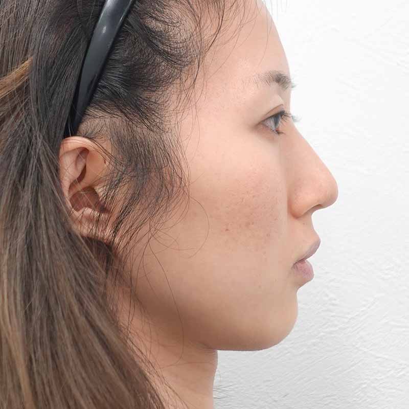 20250822_Ｇ139671_kadoya_hyaluronic nasolabial folds jaw nose.psd①Before