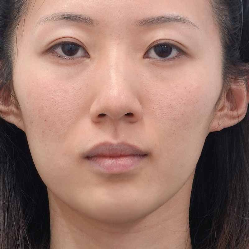 20250822_Ｇ139671_kadoya_hyaluronic nasolabial folds jaw nose.psd②Before