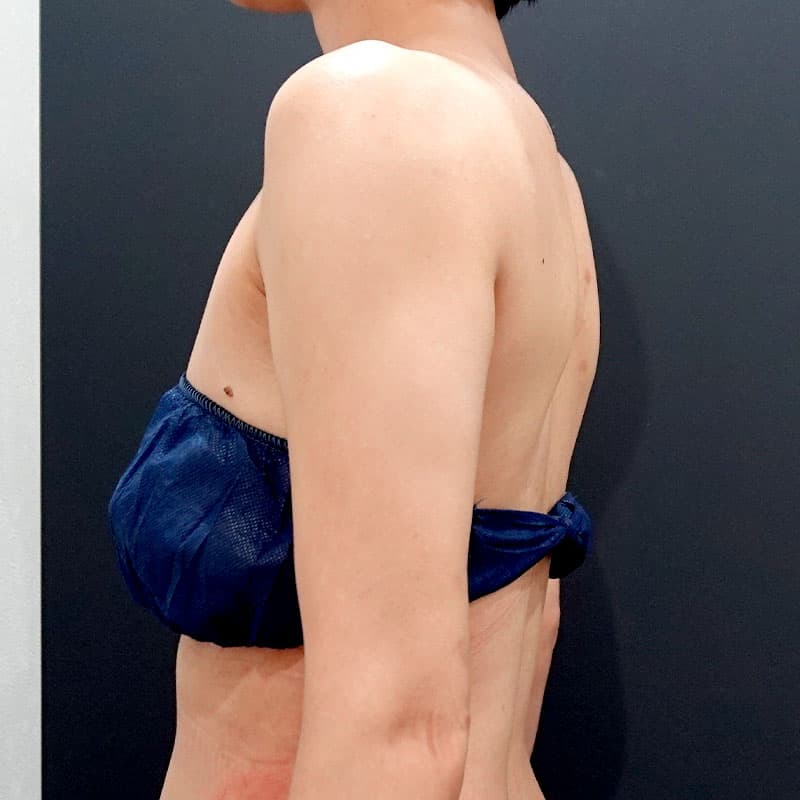 20250823_F125985_nagahama_arm-liposuction①After