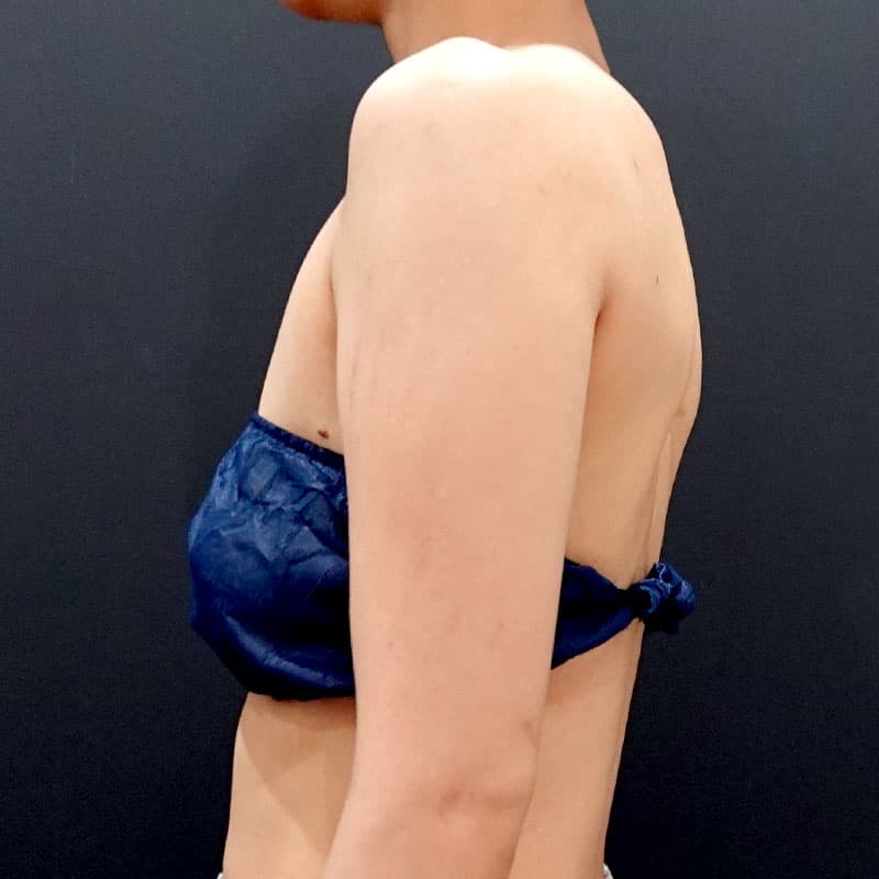 20250823_F125985_nagahama_arm-liposuction①Before