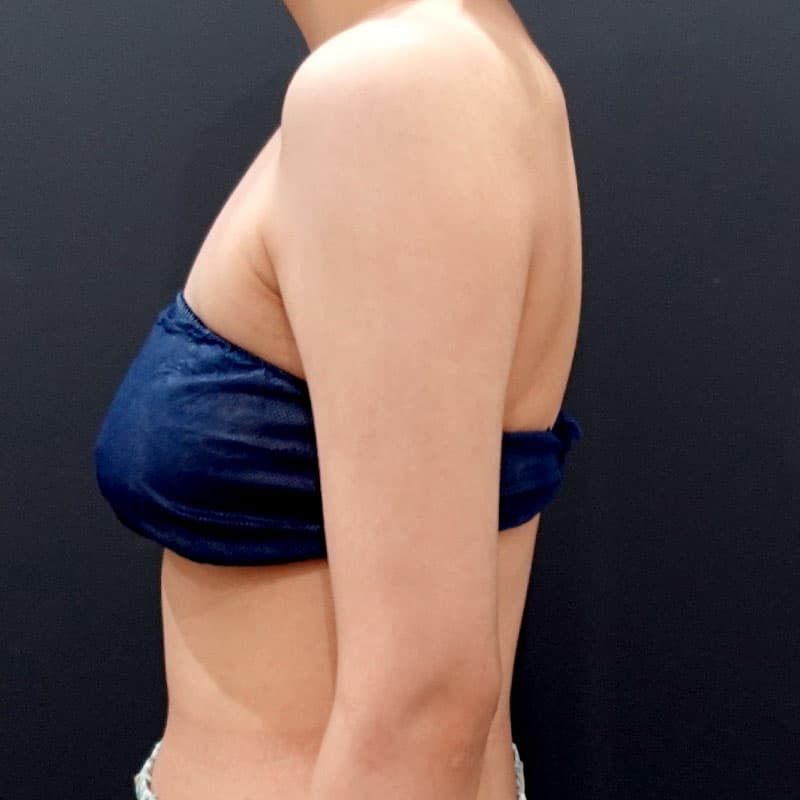 20250823_F127425_nagahama_arm-liposuction②After