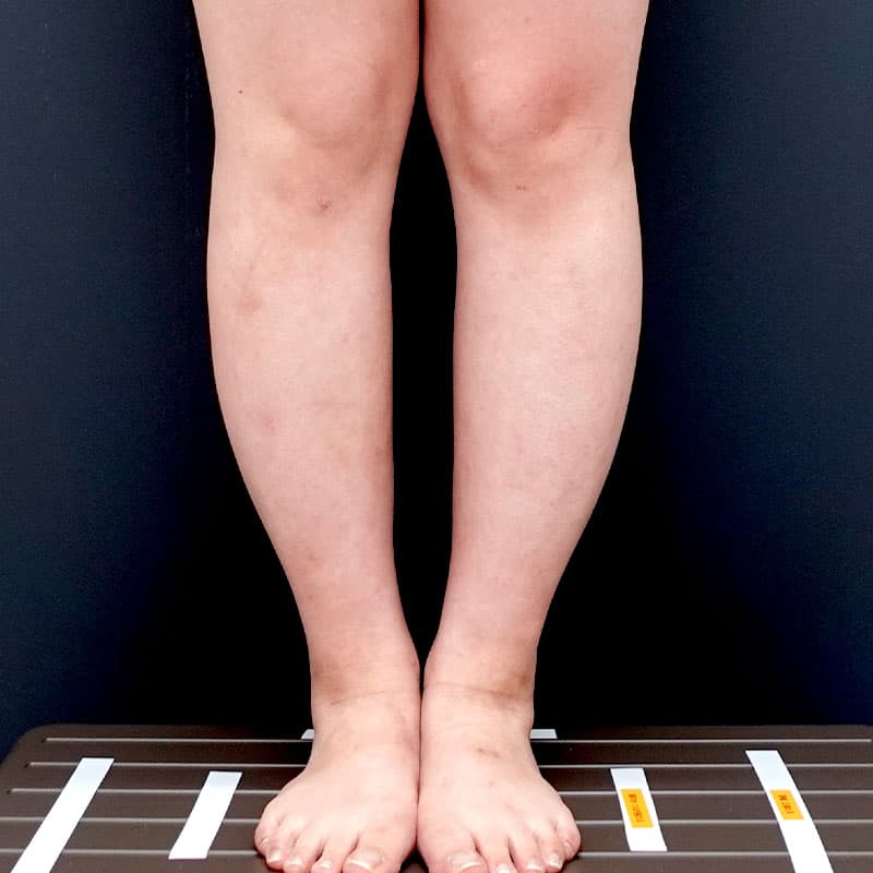 20250823_N39180_kaneko_calf-liposuction③After